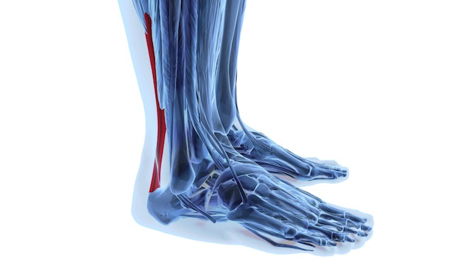 Achilles Tendon Ruptures- Prevention and Recovery