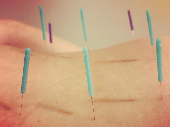 Acupuncture Needles - STACK
