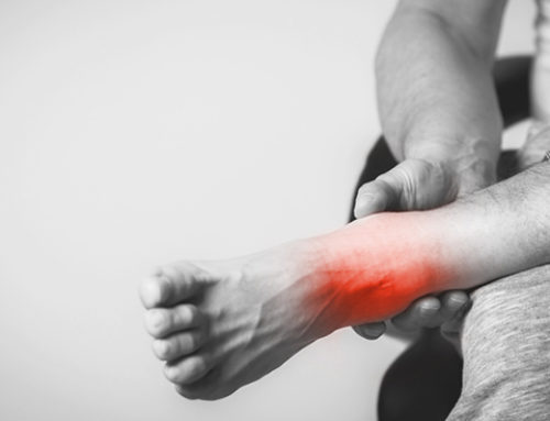 Treating an Ankle Sprain