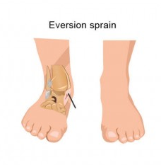 Ankle Talk: Rehabbing an Eversion Ankle Sprain - stack