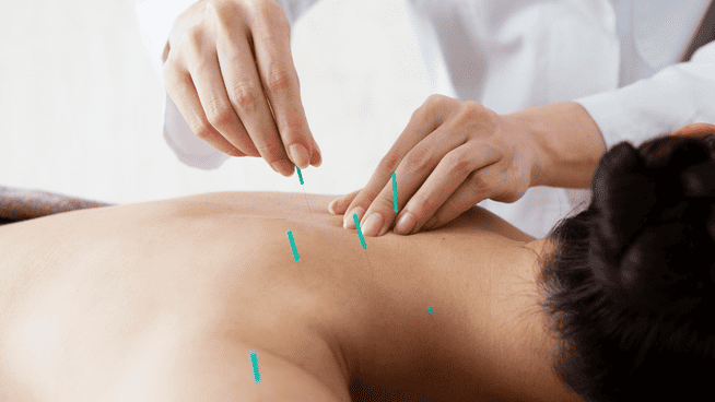 close up image of doctor performing acupuncture on patients back and neck - can acupuncture be beneficial to athlete performance? - acupuncture for sports and athletes